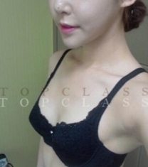 韩国顶级整形-topclass整形医院隆胸前后对比照片