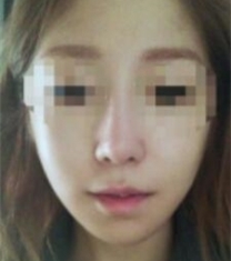 韩国博朗温整形医院轮廓鼻部整形前后照片