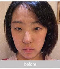 韩国朱诺整形做鼻子前后对比案例