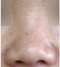 韩国ST整形网外科蒜头鼻矫正对比案例