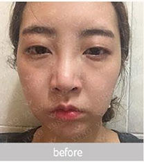 韩国朱诺整形外科-朱诺鼻金院长隆鼻前后3个月恢复照片