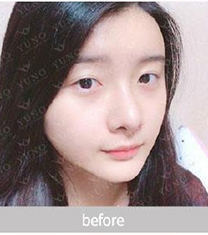 韩国朱诺整形隆鼻3个月官方恢复照片_术前