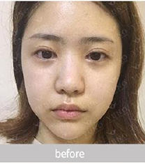韩国朱诺整形福鼻矫正案例照片