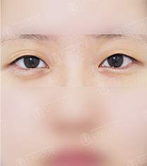 韩国优尼克双眼皮手术案例对比图_术前
