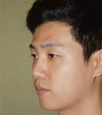 韩国可安美(CNM)男士鼻整形案例