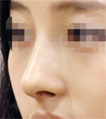 韩国olive整形外科假体隆鼻对比案例