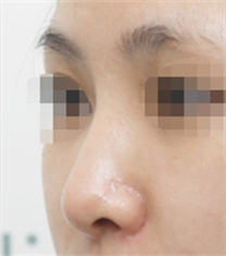 Olive整形外科-韩国olive整形外科自体软骨隆鼻对比日记