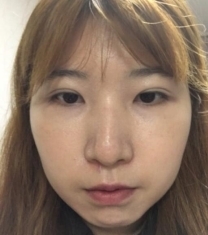 韩国本爱整形医院面部综合整形手术前后对比照片