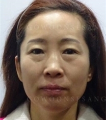 韩国高恩世上整形外科-韩国德丽珍面部抗衰老提升整形前后照片