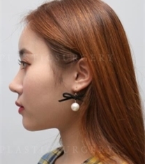 韩国高恩世上整形外科-韩国德丽珍隆鼻前后对比照片