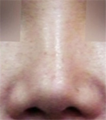 韩国ST整形网外科蒜头鼻矫正对比日记