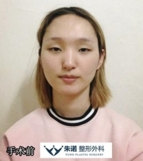 韩国朱诺整形外科-韩国朱诺整形眼鼻轮廓三件套手术前后照片