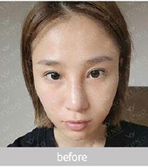 韩国朱诺鼻子修复整形官网案例