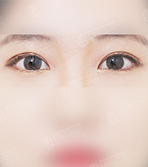 韩国优尼克双眼皮手术案例对比图_术后