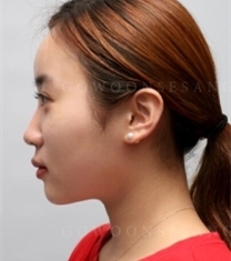 韩国高恩世上整形外科-韩国德丽珍隆鼻前后对比照片