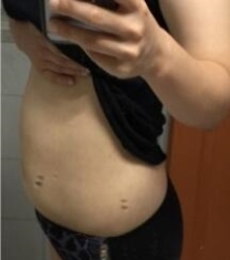 韩国维摩姜在九腰腹手臂吸脂5个月恢复照片