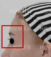 韩国白汀恒额头+眉弓混血整形案例