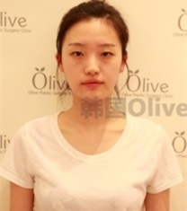 Olive整形外科-韩国Olive整形医院眼鼻整形前后照片