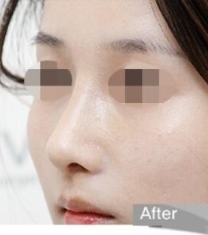 Olive整形外科-韩国Olive整形医院朝天鼻矫正前后照片