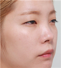 韩国佳轮韩整形-韩国佳轮韩双眼皮+鼻综合整形恢复前后对比