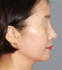 韩国able整形医院隆鼻+面部提升前后对比照片