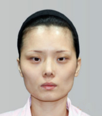 韩国博朗温v-line+眼部手术前后对比照片_术前