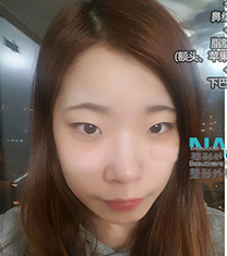 韩国那木眼鼻综合+面部脂肪填充案例对比