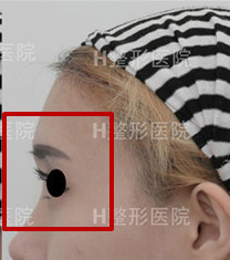 韩国白汀恒额头+眉弓混血整形案例