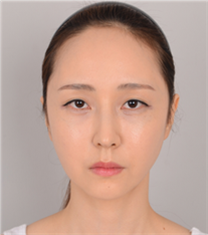 韩国jj洪镇柱整形外科面部轮廓综合整形对比