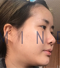 韩国mind面部吸脂+眼鼻综合整形前后案例对比