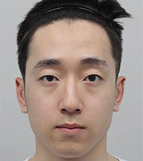 韩国DA整形-韩国DA男士面部轮廓整形对比案例