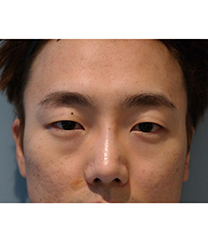 李康元整形外科-韩国清潭李康元男士眼整形前后对比照片