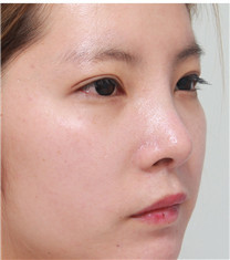 韩国佳轮韩双眼皮+鼻综合整形恢复前后对比