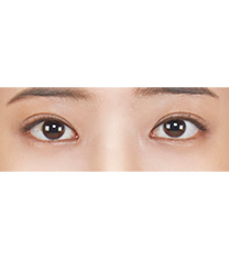 韩国ST整形外科医院-韩国ST医院眼下脂肪重制（去黑眼圈）手术真人对比