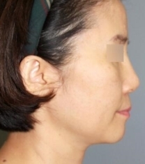 Able整形外科诊所-韩国able整形医院隆鼻+面部提升前后对比照片