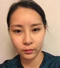 韩国Smile整形外科-韩国Smile整形蒜头鼻矫正手术前后对比照片