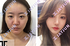jayjun吴院长双眼皮手术效果怎么样，在韩国什么档次？