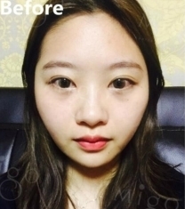 MIGO整形外科-韩国MIGO整形医院鼻综合颧骨内推手术前后照片