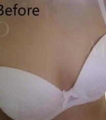 MIGO整形外科-韩国MIGO整形医院尹源晙隆胸前后对比照片