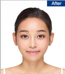 韩国德琳整形外科-韩国Dream整形医院面部轮廓+隆鼻真人案例
