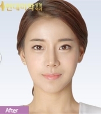 韩国现代美学眼鼻手术+面部轮廓整形前后照片_术后