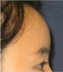 博朗温整形外科-韩国博朗温自体脂肪填充额头手术前后对比日记
