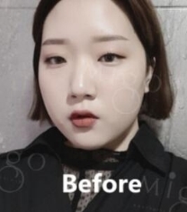 韩国MIGO眼鼻+面部吸脂整形前后对比照片