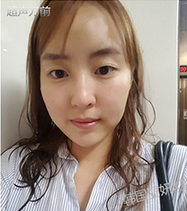 韩国丽妍k整形-韩国丽妍k超声提升面部提升真人日记对比