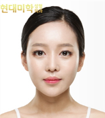 韩国现代美学整形医院-韩国现代美学双眼皮+脂肪填充案例对比