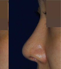 韩国rococo整形外科鼻整形案例对比