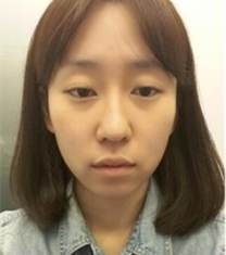 加美整形外科医院-韩国加美整形医院眼鼻面部填充前后对比照片