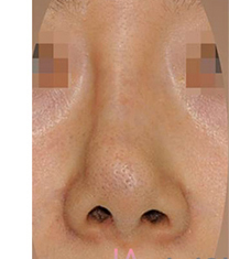 韩国拉菲安整形外科歪鼻矫正真人日记对比
