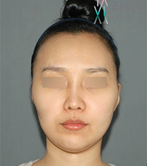 韩国拉菲安整形外科颧骨整形真人自拍对比