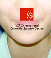 韩国VIP整形网外科四颌角整形案例对比图